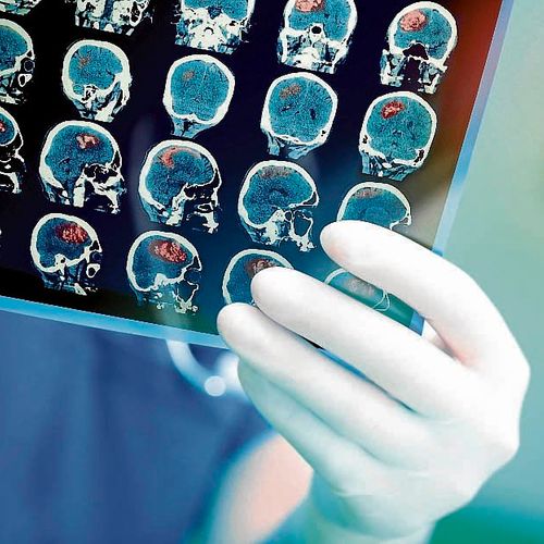Especialistas explicam as lesões que podem ficar no organismo de quem consegue alcançar a cura da Covid-19