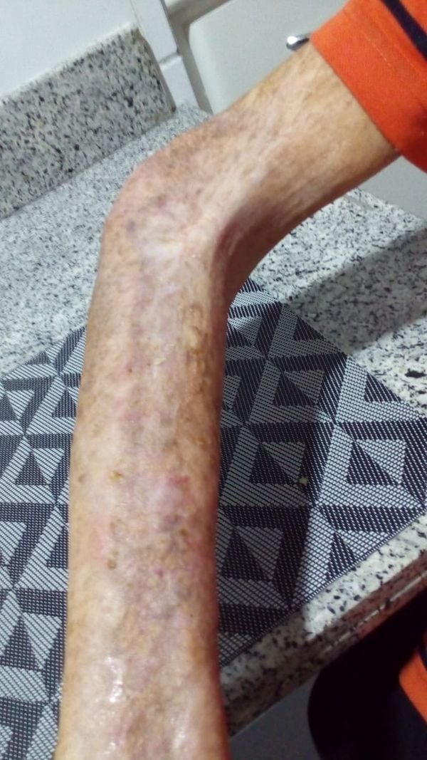 Idoso apresenta o braço já praticamente recuperado durante tratamento de criptococose. Crédito: Arquivo Pessoal