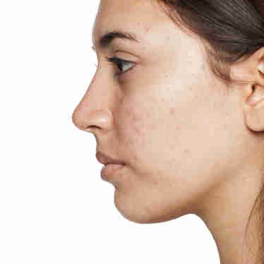 Imagem - Acne na quarentena? Dermatologistas dão dicas para melhorar a pele