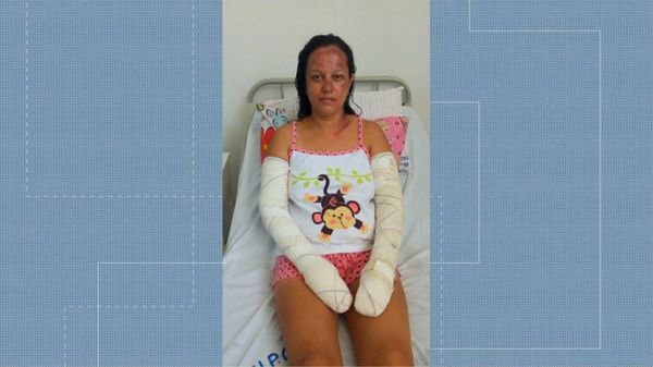 Alessandra teve queimaduras pelo corpo e está internad. Crédito: TV Gazeta