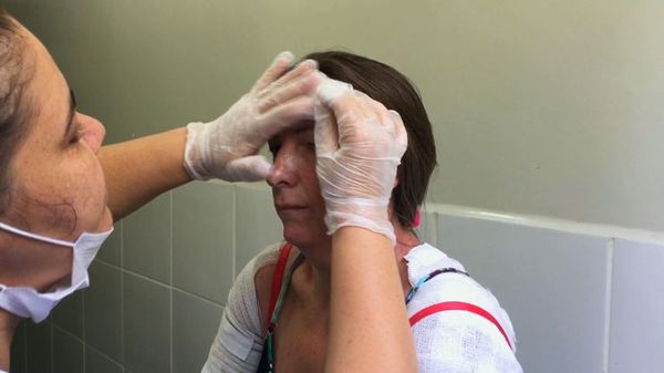 Mulher teve queimaduras no rosto e nos braços após explosão em churrasqueira, no ES. Crédito: TV Gazeta