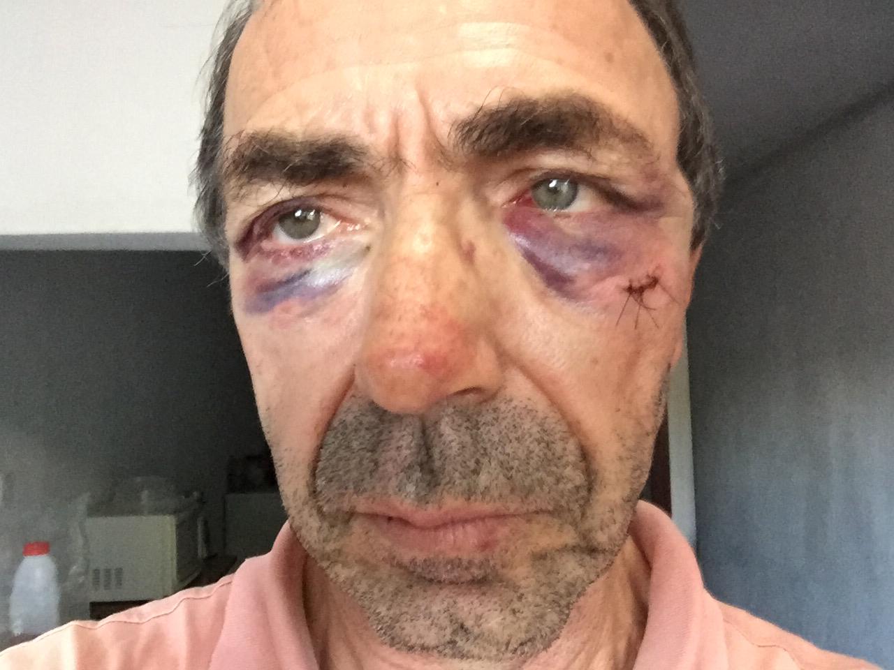 Sebastião precisou levar pontos no rosto por conta da agressão