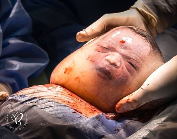Bebê empelicado bomba na web ao nascer fazendo biquinho e careta no ES. Crédito: Jana Brasil