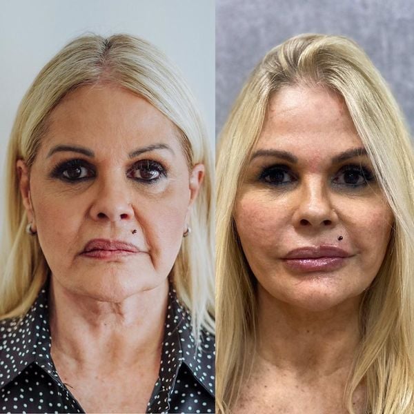 Monique Evans mostra "antes e depois" de sua harmonização facial com botox, preenchedores e fios de PDO feita em Vitória, no Espírito Santo. Crédito: Reprodução/Instagram @moniquevansreal
