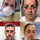 Imagem - Famosos mostram médicos com rostos marcados por máscaras apertadas