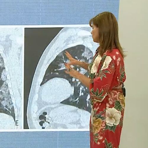 Em entrevista ao Bom dia Espírito Santo, da TV Gazeta, a pneumologista Cilea Martins explicou como o corpo se comporta após o contágio pela doença