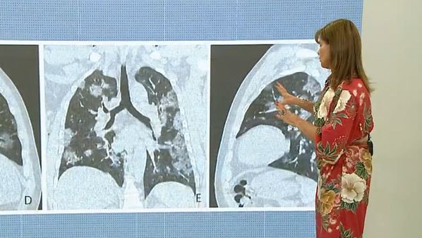 Em entrevista ao Bom dia Espírito Santo, da TV Gazeta, a pneumologista Cilea Martins explicou como o corpo se comporta após o contágio pela doença