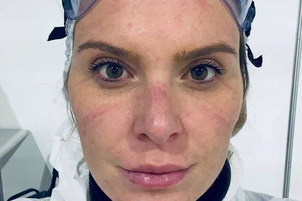 Karina Oliani mostra as marcas no rosto após um dia de trabalho em hospital de campanha