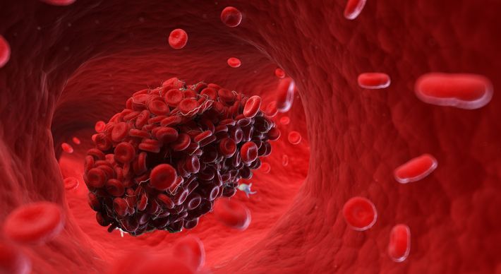 A coagulação sanguínea causada pelo novo coronavírus pode atingir diversos órgãos do corpo do infectado. Assim, tromboses surgem e causam complicações como embolia pulmonar, derrame cerebral e até amputação de membros