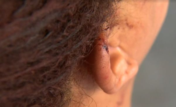 A auxiliar de serviços gerais teve graves ferimentos na orelha direita após ser mordida e agredida pelo namorado