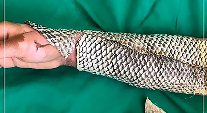 Pesquisadores brasileiros querem enviar a pele do peixe para ajudar as vítimas da explosão no Líbano. O método, usado em queimaduras profundas, acelera o processo de cicatrização além de diminuir a dor do paciente