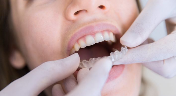 Alternativa tem sido cada vez mais escolhida por dentistas e pacientes para tratamentos ortodônticos. A opção de tratamento é mais confortável, segura e discreta