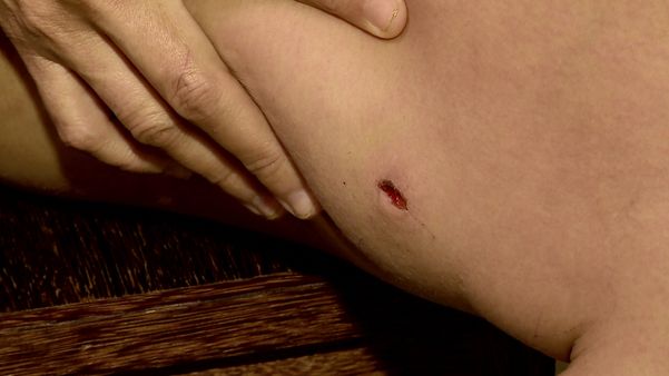 Mulher carrega ferimentos no corpo 