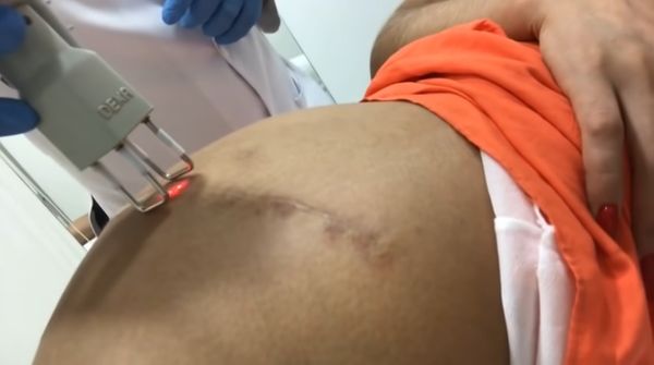 A modelo Andressa Urach remove tatuagens e cicatriz de bumbum após hidrogel com laser