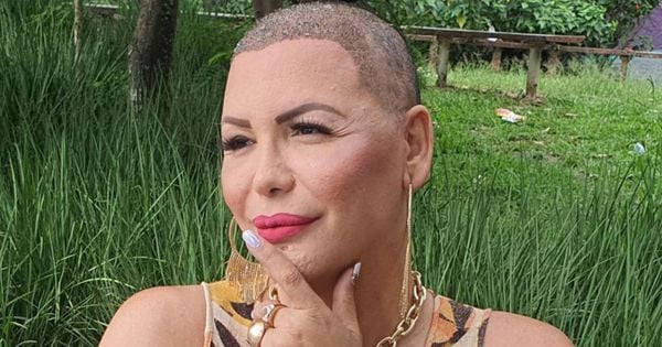 A youtuber Luisa Marilac teve que raspar o cabelo para fazer transplante capilar