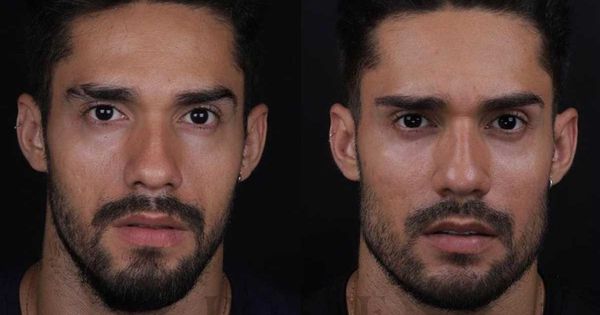 BBB 21: antes e depois de harmonização facial de Arcrebiano choca
