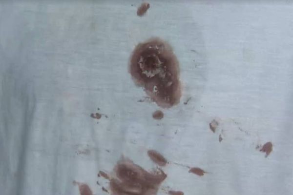 Marcas de sangue na camisa de criança de 11 anos atingida por bala perdida na Serra