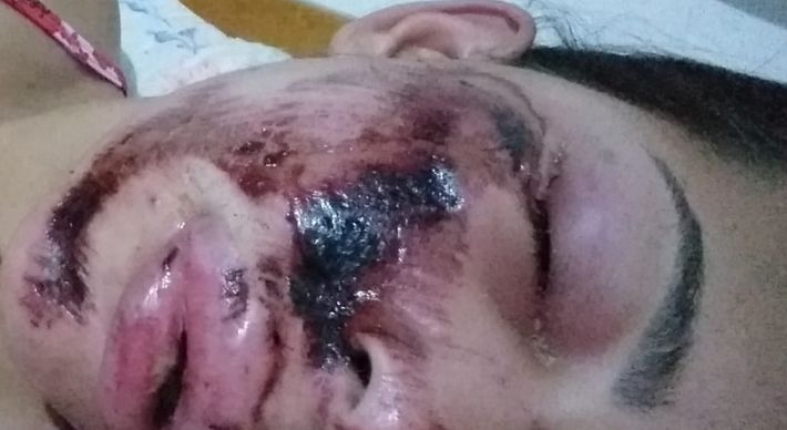 Segundo Luiza Alves Soares, o bueiro estava sem tampa na hora do acidente. Ela teve a mandíbula e o maxilar trincados, cinco dentes quebrados e ferimentos na cabeça com o impacto da queda