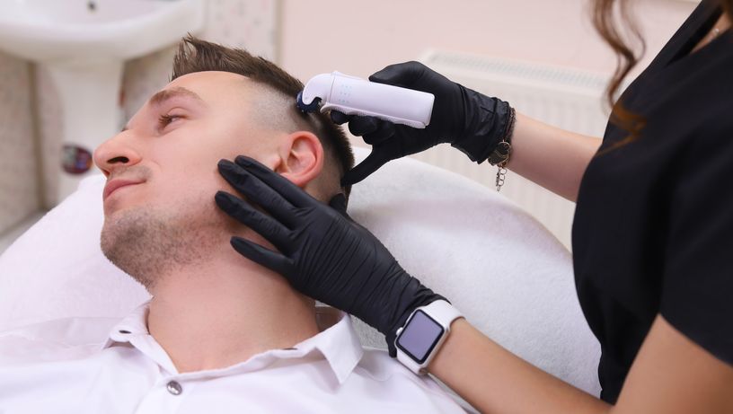 Microagulhamento é eficaz para injetar substâncias direto no couro cabeludo