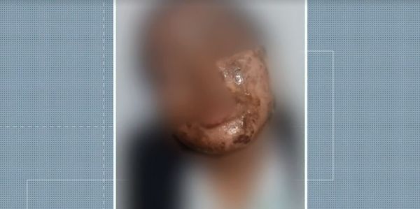 Jovem queimada com ácido na Serra