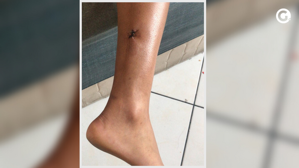 Bala perdida atingiu a panturrilha direita da jovem de 26 anos