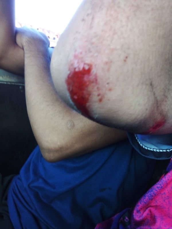 Ítalo ficou machucado após ser atropelado por cavalo em Vila Velha