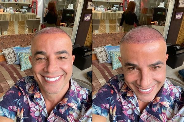 O ator Anderson Di Rizzi após fazer o transplante capilar