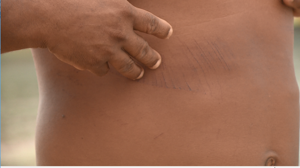 Escoriações pelo corpo do pescador Arlei Lacerda de Freitas.