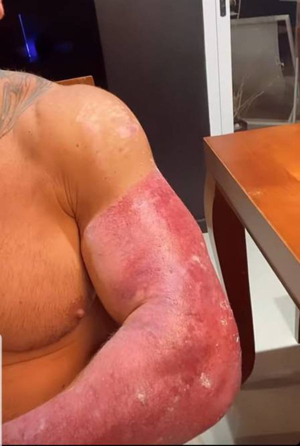 Leo Stronda mostra cicatriz no braço após cirurgias. O youtuber foi vítima de uma explosão de botija de gás