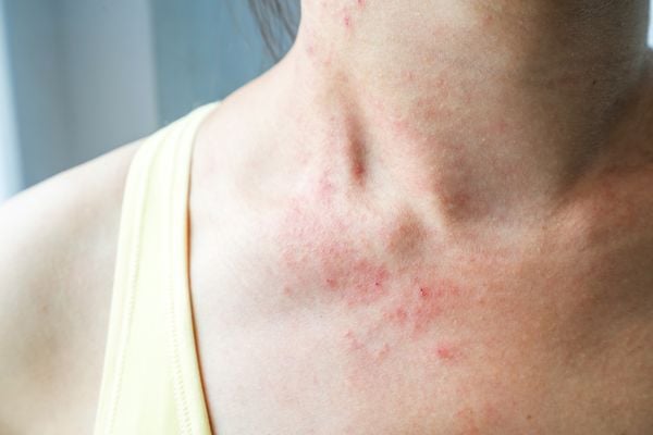 Mulher jovem tem prurido de pele no pescoço, alergia