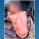 Imagem - Homem é agredido e tem parte do corpo queimado em Vila Velha