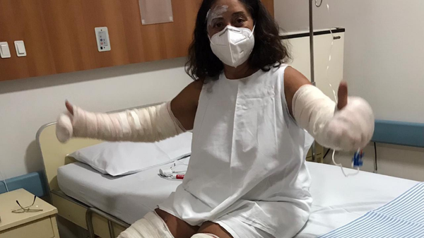 Marlene Moreira tem queimaduras pelo corpo após acidente com desodorante