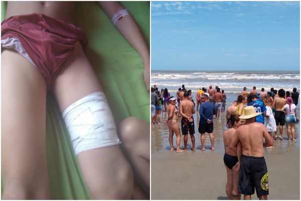 Menino foi ferido por tubarão em Ilha Comprida, São Paulo