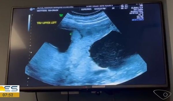 Amanda Altoé sofreu dez abortos e, há sete meses, descobriu a gravidez de gêmeos