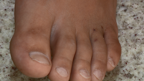 As marcas do acidente com o escorpião ainda estão no pé de Arthur Bettero Afonso, de 11 anos.