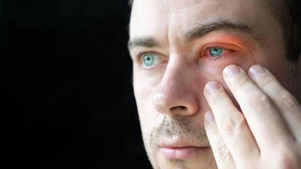 Conjuntivite, olhos