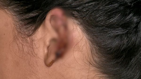 Homem arranca parte da orelha da ex-mulher durante briga em Vila Velha