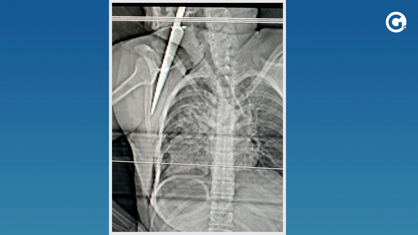 Raio-X mostra lâmina cravada no corpo da mulher