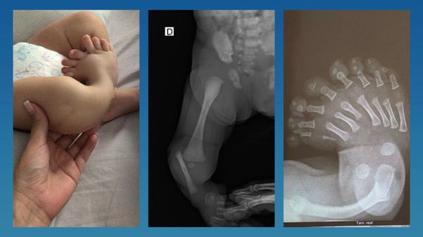 À esquerda fica clara a má formação na perninha do pequeno Gael. No centro, o raio-X que revela a ausência da tíbia. À direita, um raio-X do pé dele, que tem oito dedos