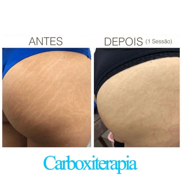 Carboxiterapia é um dos tratamentos realizados na clínica Semblant, em Vitória.