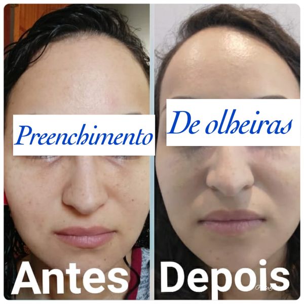 Entre os procedimentos realizados na Semblant está o de preenchimento de olheiras.
