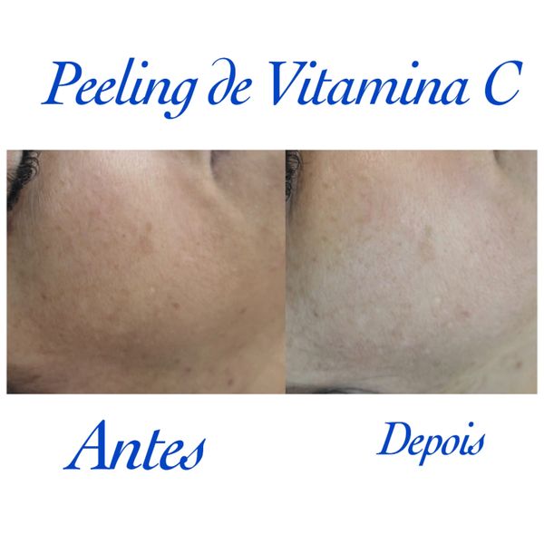 Peeling de vitamina C é um dos tratamentos realizados na Semblant.