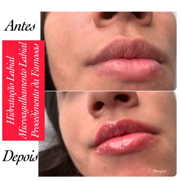 Tratamentos estéticos podem ser uma alternativa ao preenchimento labial.