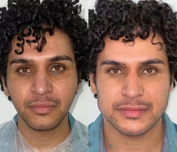 A transformação de Charles Teixeira após a harmonização feita em São Paulo na última sexta-feira (25)
