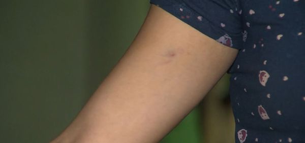 Mulher grávida foi agredida pelo namorado na Serra ficou com vários hematomas pelo corpo