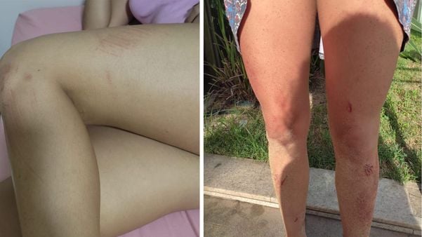 Caso barriga aberta: Lesões apresentadas por Lívia Lima Simões Paiva Pereira, 20 anos, namorada do rapaz que teve abdômen aberto e intestino exposto em Guarapari