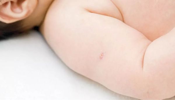 A vacina BCG é geralmente aplicada em recém-nascidos e famosa por deixar a marquinha para o resto da vida