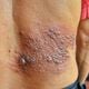 Imagem - Herpes-zóster: nova vacina já está disponível em clínicas particulares