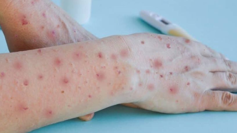 Varíola dos macacos: ES investiga caso