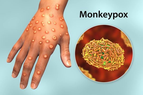 Varíola dos macacos: doença causada pelo monkeypox é considerada emergência mundial